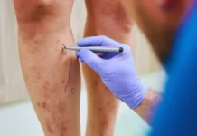 Si ndikojnë të ftohtit dhe kushtet atmosferike në venat dhe cilat simptoma kërkojnë reagim urgjent