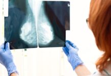 Revolucion në trajtimin e kancerit të gjirit, testi i ri i studiuesve britanikë përcakton se cila terapi është më efektivja për pacientin