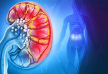 Pse guri në veshka kthehet sërish? Zbulimi i ri sfidon bindjet e vjetra mjekësore