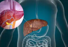 Mëlçia e dhjamosur, sëmundja e heshtur që po prek miliona njerëz në botë