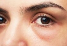 Qeskat nën sy, si t’i parandaloni dhe largoni