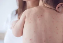 Alarm për fruthin/ Shpërthim infektimesh në një kopsht në Tiranë, 15 fëmijë të prekur