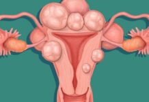 Çfarë janë fibromat e mitrës dhe ja çfarë duhet patur parasysh