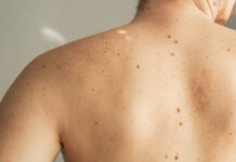 Pse disa njerëz kanë shumë nishane?