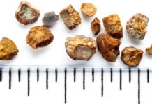 Si të kuptoni nëse keni gurë në veshka – Çfarë duhet të bëni?