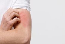 Dermatologët: kruajtja e trupit mund të fshehë sëmundje serioze