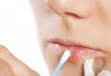 Mënyra natyrale për të shëruar herpesin e buzës