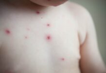 Çfarë duhet bërë kur fëmijët infektohen me fruth në çerdhe. Përgjigjet pediatrja!
