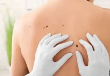 4 faktorë që shkaktojnë kancer të lëkurës